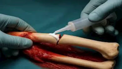 ابتكار صيني يعالج كسور العظام في 3 دقائق فقط "التفاصيل"