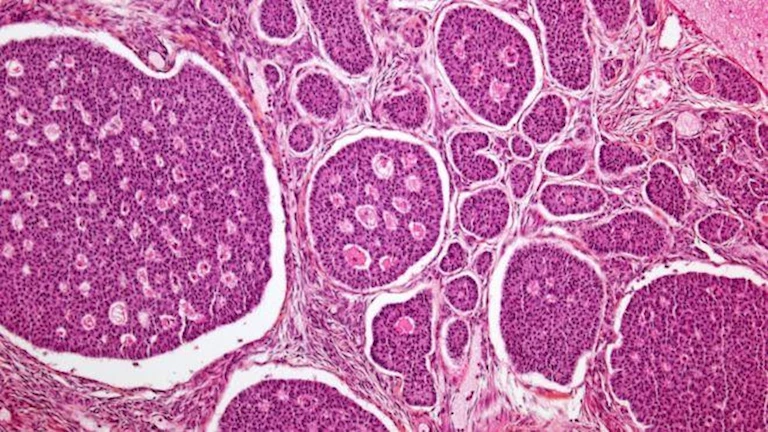 علامات تحذيرية تكشف إصابتك بسرطان العمود والبنكرياس والطحال.. احذر تجا