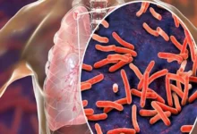 الأكثر فتكًا بالعالم.. الصحة العالمية: وفاة أكثر من مليون شخص بمرض الس