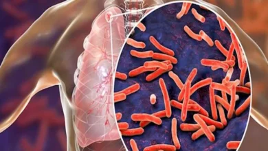 الأكثر فتكًا بالعالم.. الصحة العالمية: وفاة أكثر من مليون شخص بمرض الس